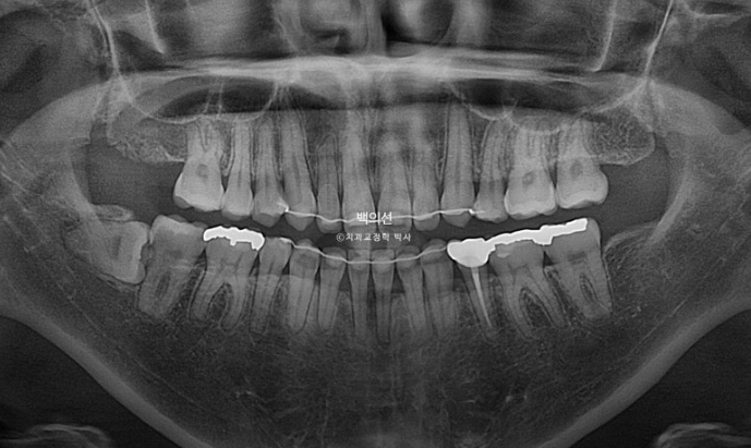 30대 치아교정 돌출입 교정 :: 잇몸미소 거미스마일 교정 입술부전증 결손치 무턱교정 관련 이미지 26