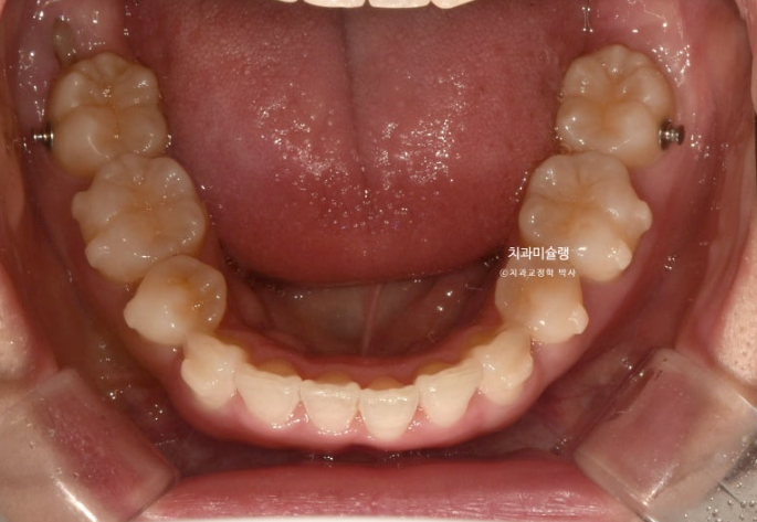 돌출입 덧니 발치 교정 인비절라인 교정 후기 관련 이미지 13