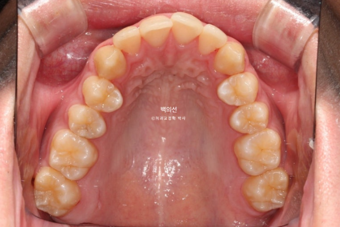 유학생 교정 인비절라인 라이트 치료기간 5개월 관련 이미지 4