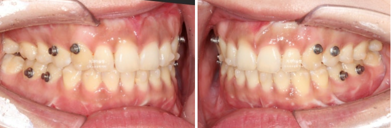 선수술 양악수술 비대칭 주걱턱 잇몸미소 치료 인비절라인 라이트 관련 이미지 8