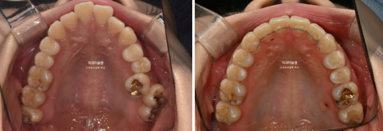 비발치 돌출입 인비절라인 교정 가위교합 중심선 맞추기 관련 이미지 20