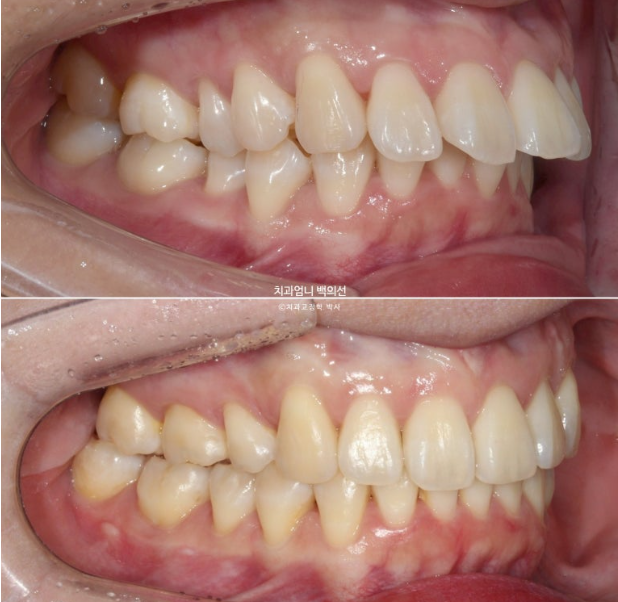 돌출입 교정 인비절라인 발치 교정 후기 관련 이미지 17