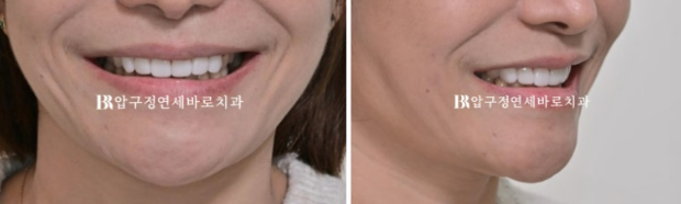 벌어진 앞니, 바로 라미네이트 하지 않은 이유｜인비절라인 후 무삭제 라미네이트 실제 사례 관련 이미지 20
