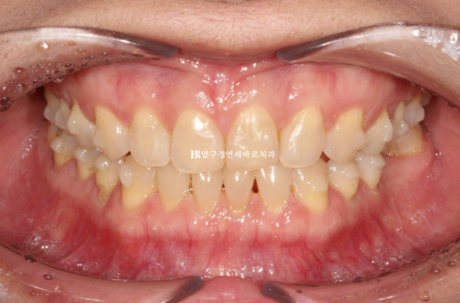 벌어진 치아 교정 인비절라인 라이트 무삭제 라미네이트 치료 관련 이미지 8