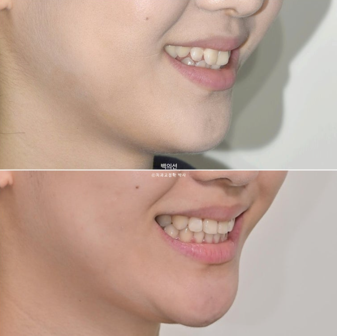비발치 덧니교정 인비절라인 교정 사랑니 이용 교정 관련 이미지 21