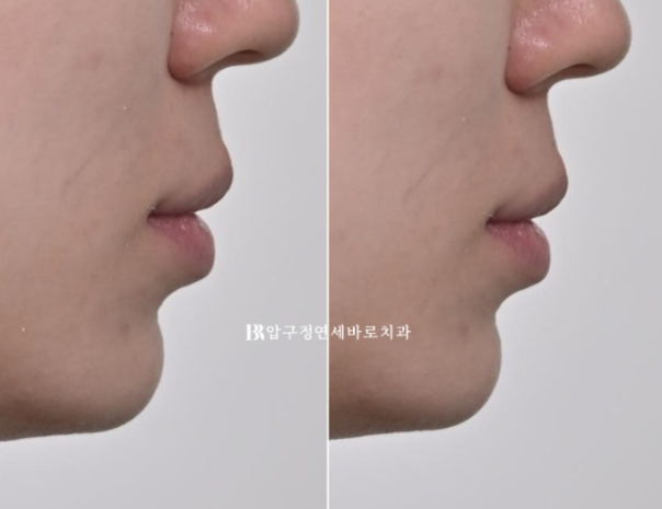 거미스마일 교정 전후 비교|웃는 얼굴이 달라졌습니다 관련 이미지 13
