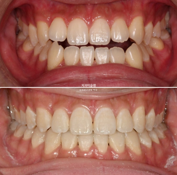 비수술 비발치 주걱턱 절충치료 클리피씨 개방교합 반대교합 치료 관련 이미지 14