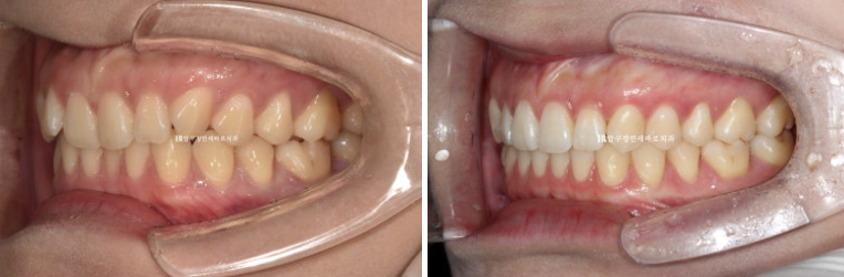 옥니 교정 인비절라인 라이트 옹니 덧니 치료기간 ? 관련 이미지 11