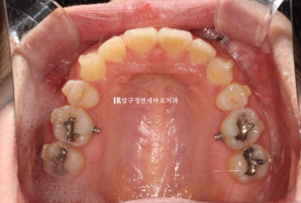 Can't Invisalign Move the Roots? An Actual Case of Extraction Treatment for Protruding Mouth at a Gangnam Orthodontic Clinic image 7