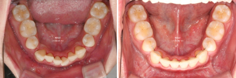 돌출입 수술 ASO + 인비절라인 라이트 후교정 치료기간 10개월 관련 이미지 15