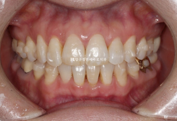 Can Invisalign Lite Work for People in Their 50s? A Real Middle-Aged Orthodontic Case Improving Butterfly Teeth and Gum Recession image 6
