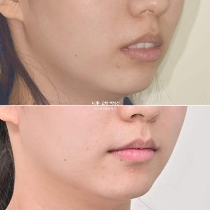 비발치 인비절라인 교정 돌출입 교정 후기 관련 이미지 19