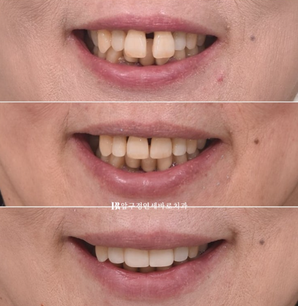 60대 치아교정, 치주염이 있어도 가능할까요? 관련 이미지 11