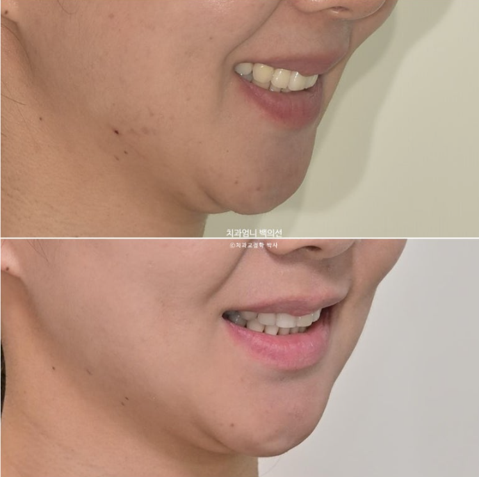 옥니 역교정 재교정 무턱 교정 치료기간 1년 10개월 관련 이미지 1