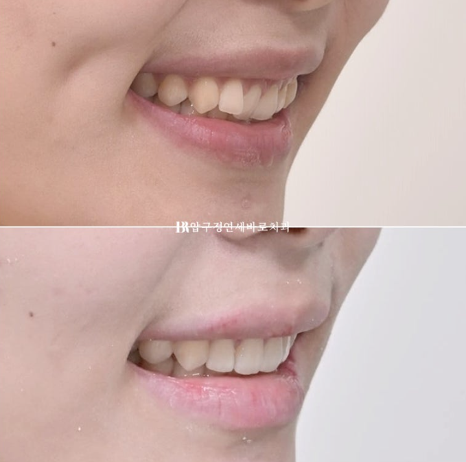 옥니 교정 인비절라인 라이트 옹니 덧니 치료기간 ? 관련 이미지 16