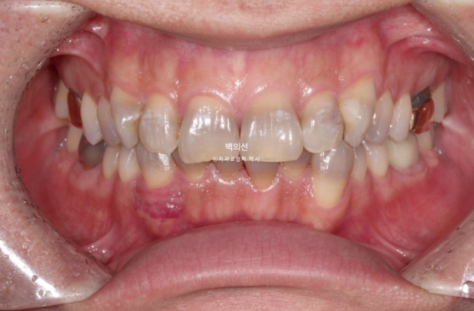 Treatment Review: No-Prep Laminate for Tetracycline-Stained Teeth image 2