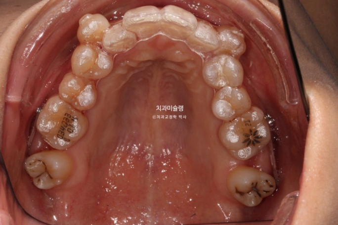 인비절라인 비발치 제2대구치 발치 사랑니 대체 교정 심한 덧니 교정 치료 관련 이미지 10