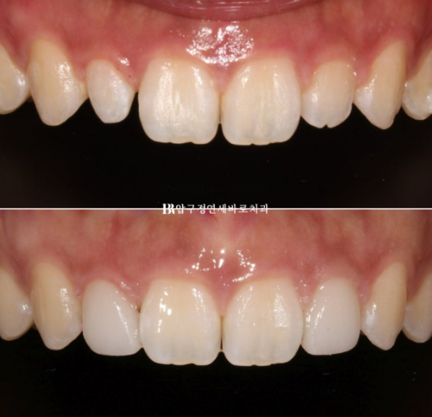 왜소치 인비절라인 라이트 교정 / 무삭제 라미네이트 젤라미 관련 이미지 8