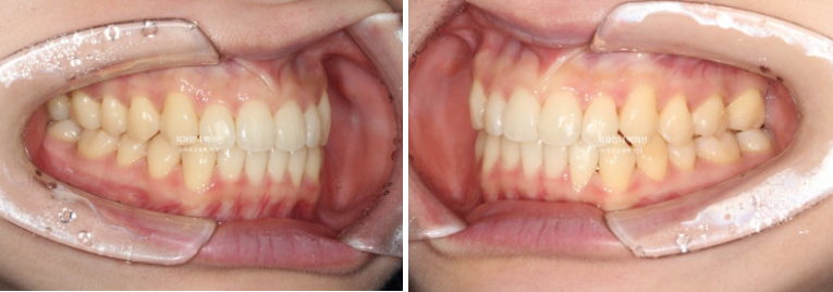 인비절라인 교정 비발치 비대칭 덧니 중심선 선천적 결손치 교정? 관련 이미지 15