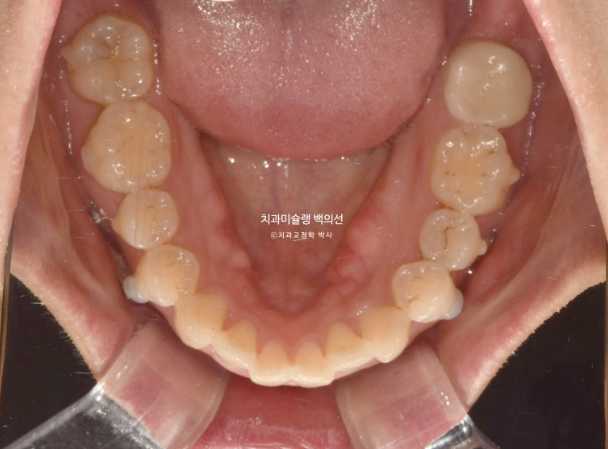 인비절라인 돌출입 발치교정 임플란트 없이 사랑니 대체 관련 이미지 13