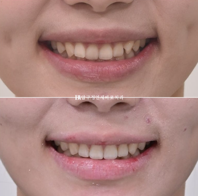 옥니 교정 인비절라인 라이트 옹니 덧니 치료기간 ? 관련 이미지 15