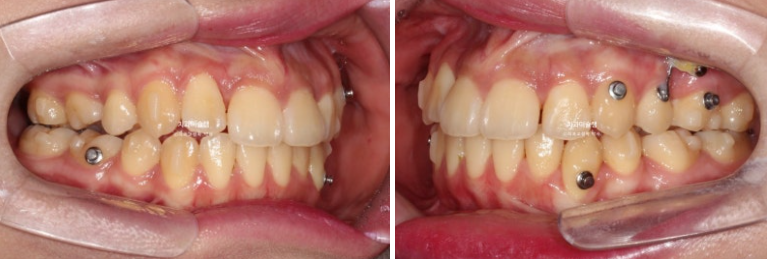 30대 인비절라인 덧니 발치교정 개방교합 치료 관련 이미지 10