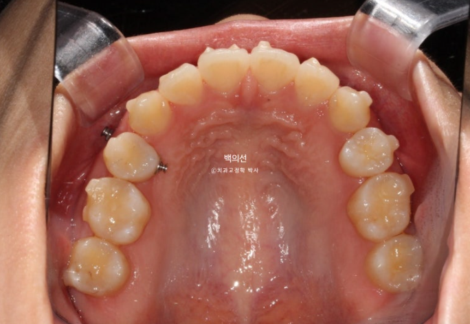 돌출입 교정 인비절라인 발치 교정 개방교합 치료 후기 관련 이미지 17