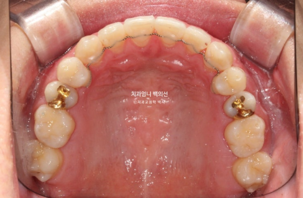 MSE Palatal Expansion Invisalign Underbite Correction, Non-Surgical image 16