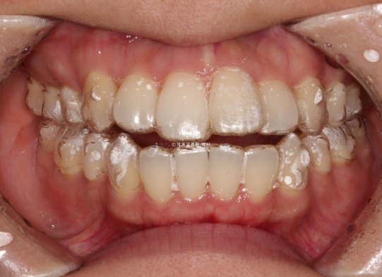 30대 돌출입 덧니 교정 인비절라인 발치교정 후기 관련 이미지 6