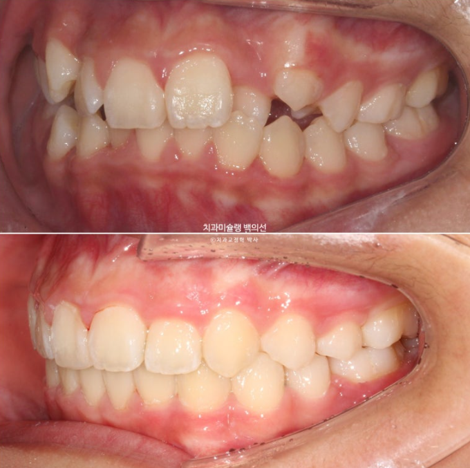 덧니 반대교합 과개교합 인비절라인 퍼스트 악궁확장 어린이 교정 치료 관련 이미지 24