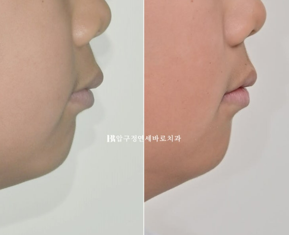 Invisalign First Correction for a Retruded Chin in a Child Orthodontic Treatment for Protrusion image 24