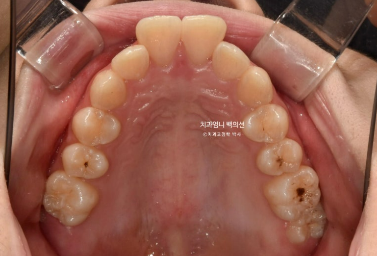 입이 안 다물어짐 입술부전증 호두턱 교정? 관련 이미지 4