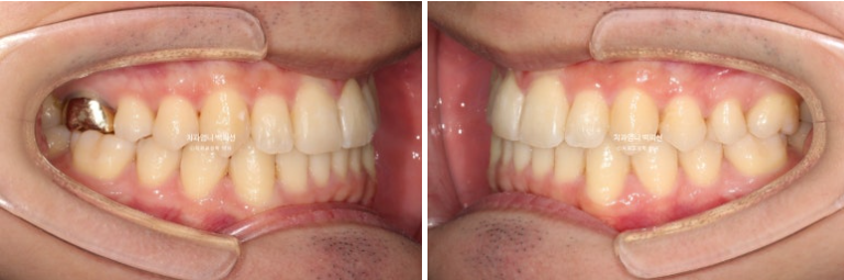 인비절라인 비발치 앞니 돌출 덧니 교정 ? 관련 이미지 11