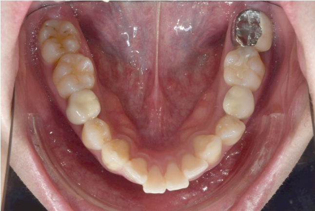 돌출입 발치 교정 인비절라인 후기 미니스크류 관련 이미지 5