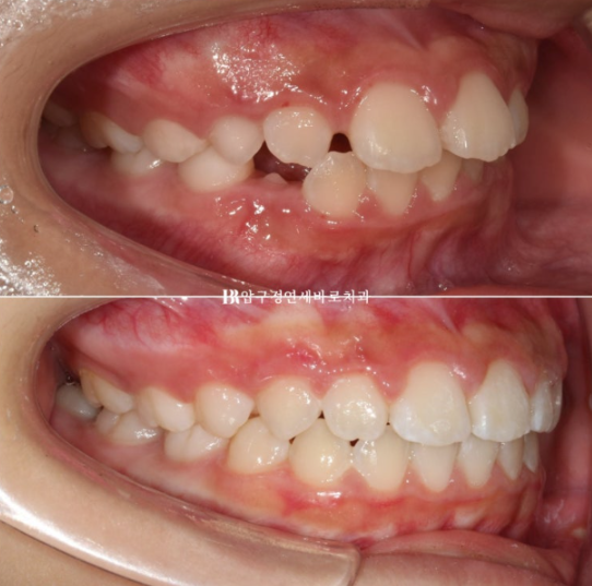강남 소아교정 인비절라인 퍼스트 어린이 반대교합 관련 이미지 14