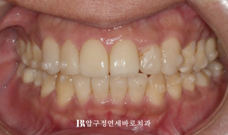 40대 중년 치아교정 인비절라인 라이트 치료기간 8개월 관련 이미지 7