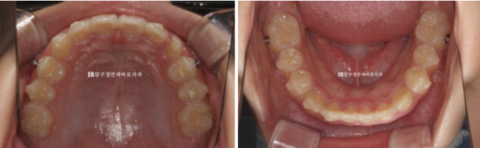 Pediatric Clear Aligners That Improved Both Deep Bite and Protruding Teeth image 12