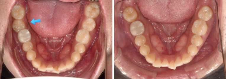 가위교합 나비치아 미니스크류 덧니 교정 인비절라인 라이트 관련 이미지 10