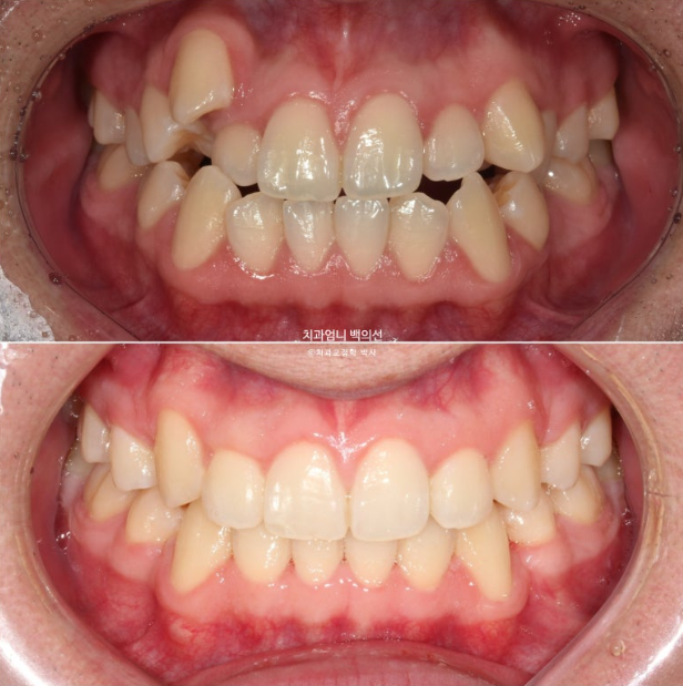 투명교정 인비절라인 덧니 교정 치료기간 알아보기 관련 이미지 11