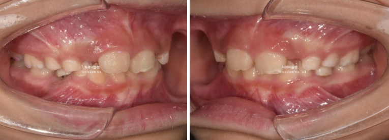 어린이 투명교정 인비절라인 퍼스트 과개교합 교정 후기 관련 이미지 3
