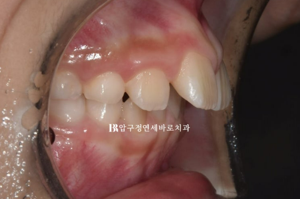 Invisalign First Correction for a Retruded Chin in a Child Orthodontic Treatment for Protrusion image 3