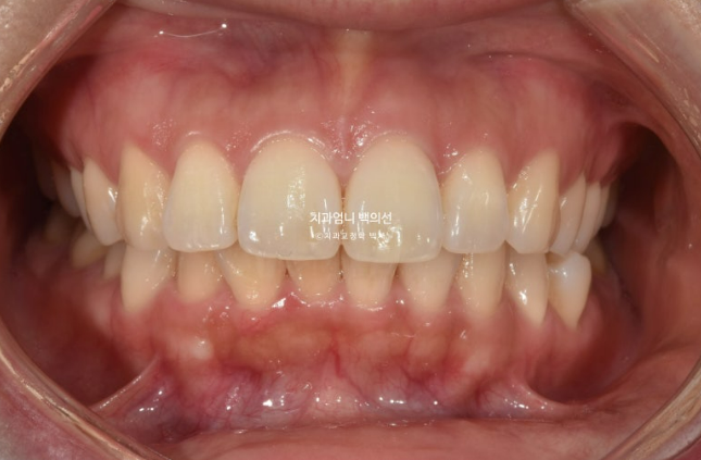 30대 돌출입 발치교정 입술부전증 치료 관련 이미지 2