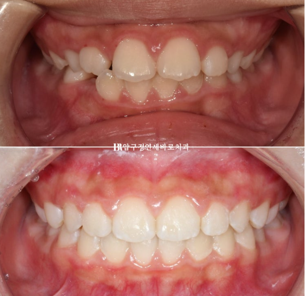 A Child’s Protruding Teeth Correction Review: Difficulty Closing the Lips image 1