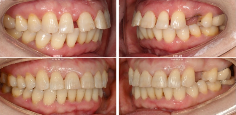 50대 치아교정 돌출 치아벌어짐 중년교정 관련 이미지 17