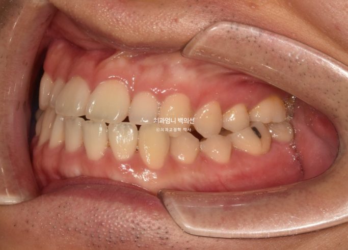 주걱턱 교정 반대교합 소구치 선천적 결손 부정교합 비발치 교정 후기 관련 이미지 3