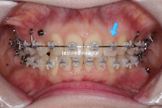 Actual Case of Treating Congenitally Missing and Peg-Shaped Teeth Without Implants image 7