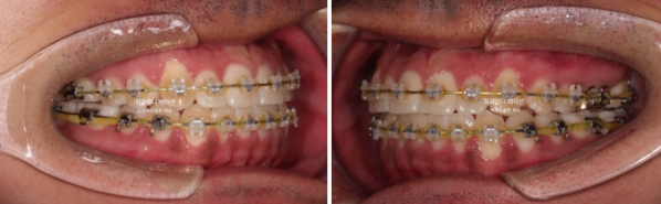 반대교합 비발치 교정 클리피씨 후기 관련 이미지 5
