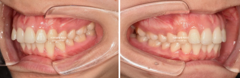 비발치 인비절라인 교정 돌출입 교정 후기 관련 이미지 3