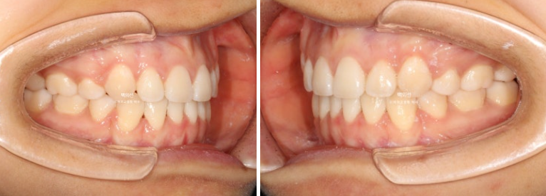 덧니 발치교정 클리피씨 입매 부작용 인중 입술 잇몸 퇴축 관련 이미지 11