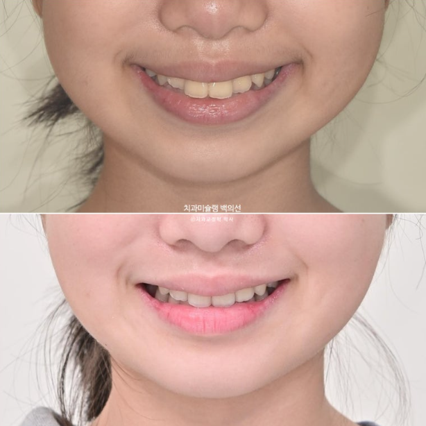 돌출입 무턱 인비절라인 발치교정 덧니 치료기간 1년 11개월 관련 이미지 16